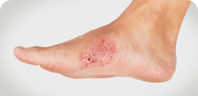 Venous stasis ulcerations wound care conditions