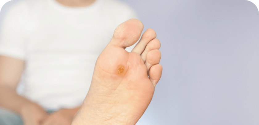 diabetic foot wound treatments and conditions